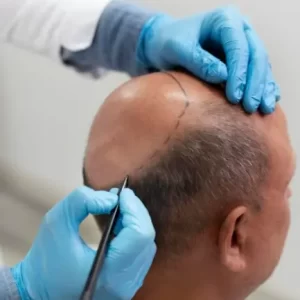 عوامل موثر در انتخاب روش کاشت مو رشت برای افراد