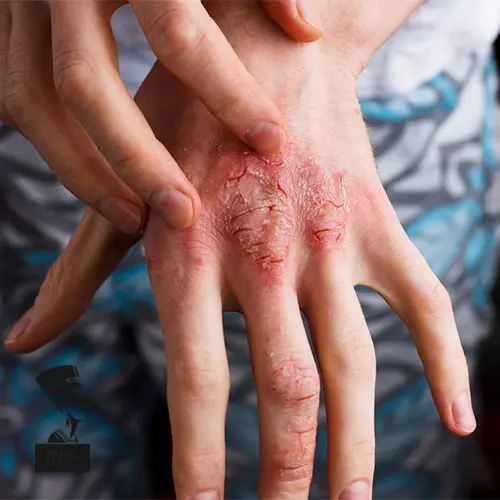 اگزمای پوستی (Atopic dermatitis)