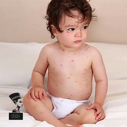 آلرژی پوستی در کودکان