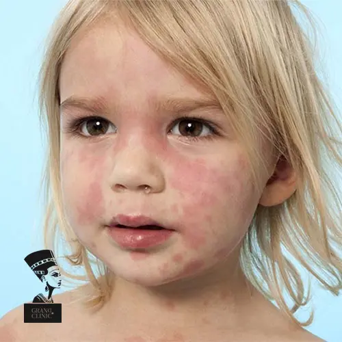 آلرژی پوستی در کودکان